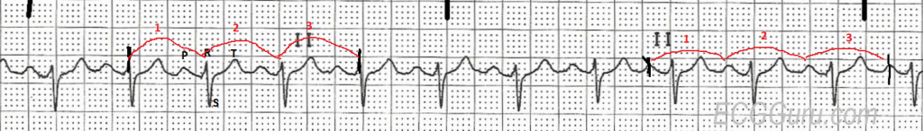 Sinus tachycardia