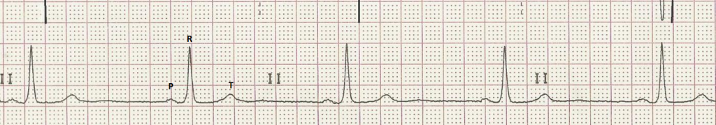 Sinus Bradycardia