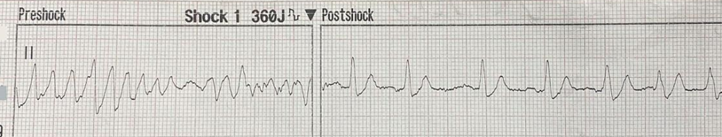 Defibrillation from Vfib into sinus rhythm