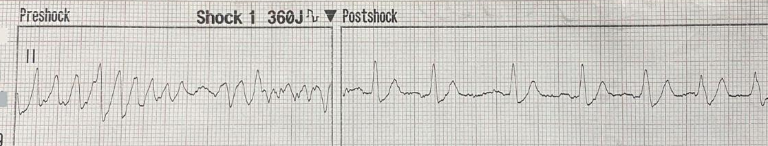 Ventricular Arrhythmias – Cardiac Rehabilitation for the Clinical ...