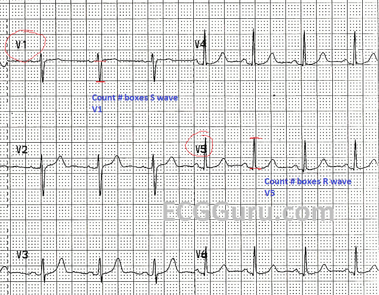 QRS voltage