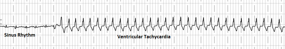 Vtach after PVC