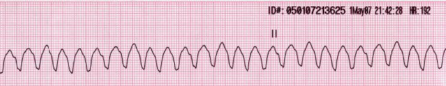 Ventricular Tachycardia