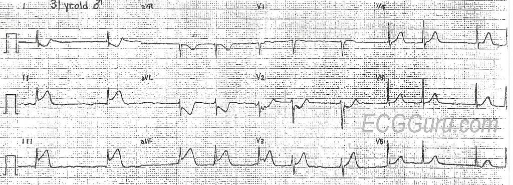 Acute MI