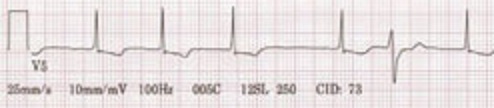 Afib with PVC