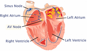 Atrial fibrillation. Chaotic firing around pulmonary veins