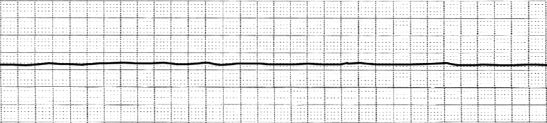 Asystole