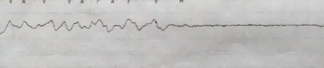 Vfib into asystole