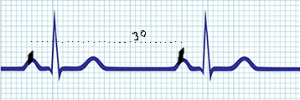 Atrial rate determination