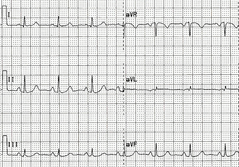 QRS axis practice