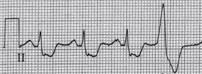 Case II ecg