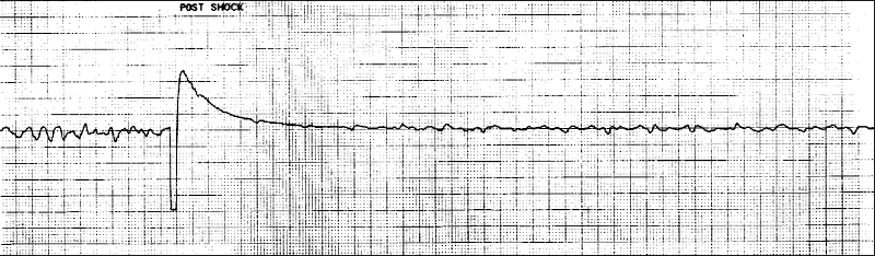 Unsuccessful Defibrillation of Vfib