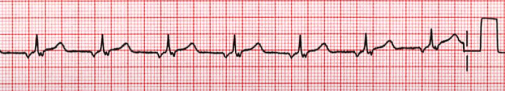 Accelerated junctional rhythm