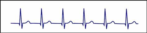 Junctional rhythm (no p waves)