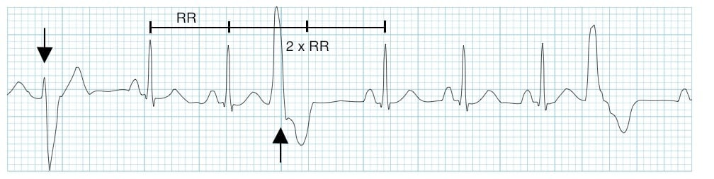 Multifocal PVCs