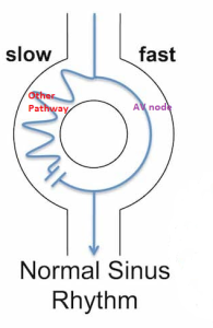 NSR with reentrant pathway