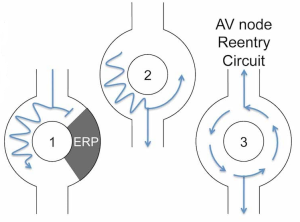 Creation of a reentrant circuit