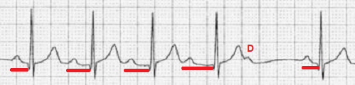 2nd degree AV block type I