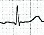 normal q wave