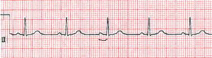 PR interval