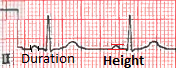 P wave size