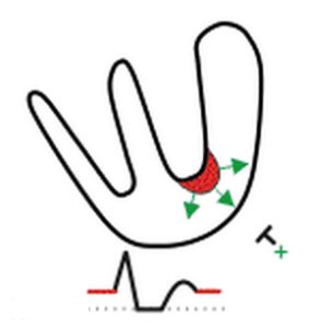 Subendocardial ischemia