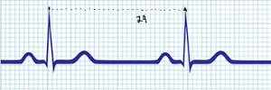 Calculating ventricular rate