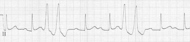 Unifocal ventricular couplets