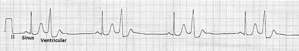 Ventricular bigeminy