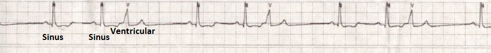 Ventricular Trigeminy