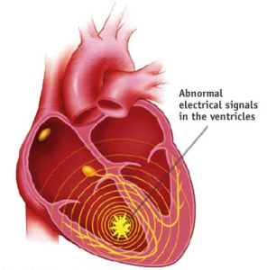 Site of ectopic ventricular arrhythmia